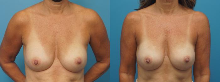 Before & After Breast Reconstruction with Implants Case 447 Front View in North Shore, IL