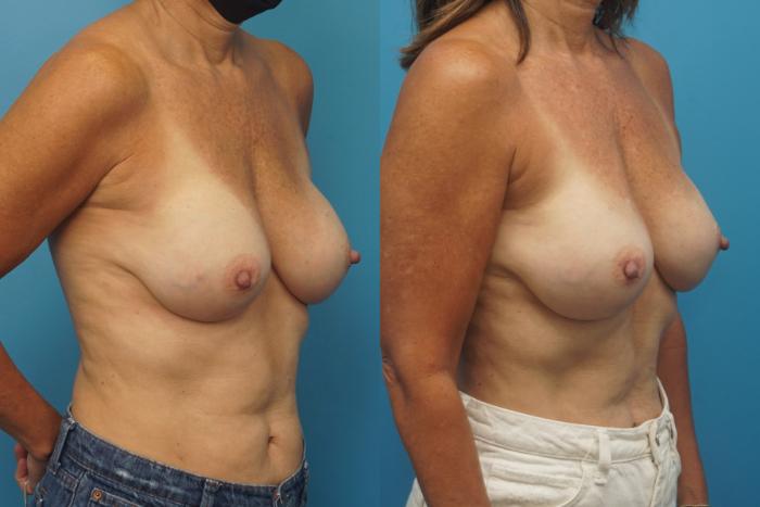 Before & After Breast Reconstruction with Implants Case 447 Right Oblique View in North Shore, IL