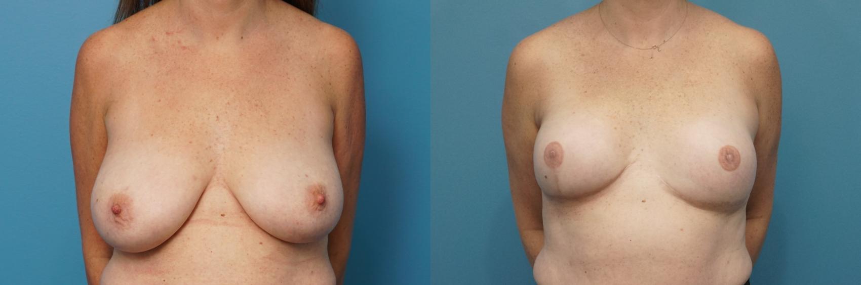 Before & After Breast Reconstruction with Implants Case 448 Front View in North Shore, IL