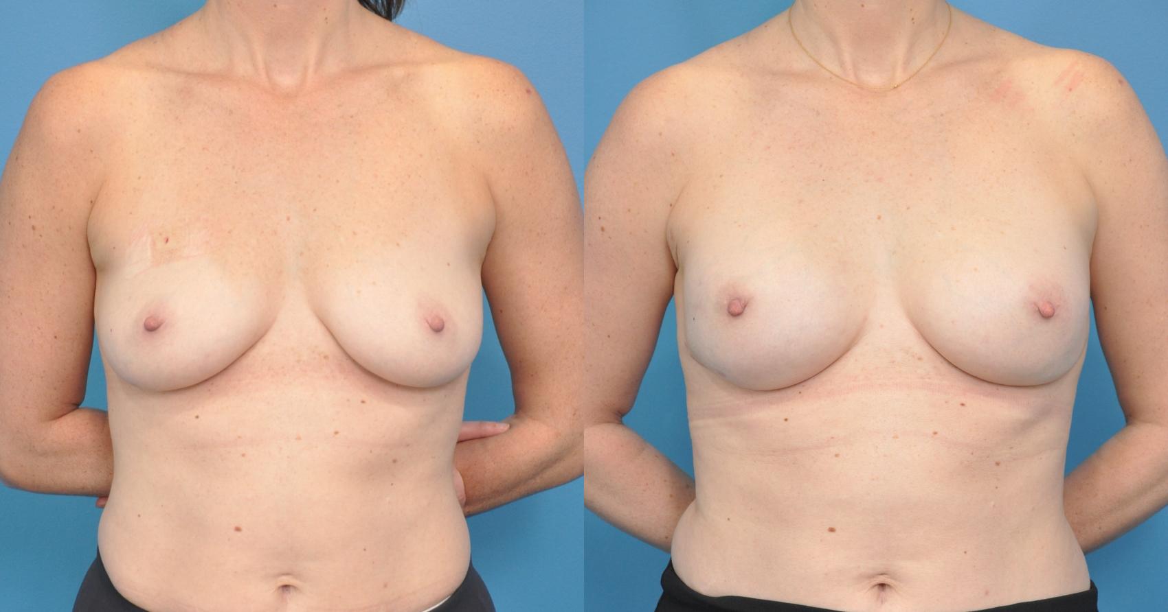 Before & After Breast Reconstruction with Implants Case 45 View #1 View in North Shore, IL