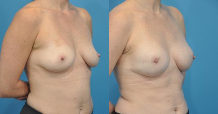 Before & After Breast Reconstruction with Implants Case 45 View #2 View in Northbrook, IL
