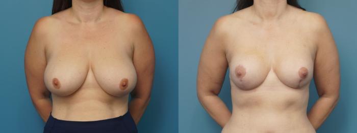 Before & After Breast Reconstruction with Implants Case 453 Front View in North Shore, IL