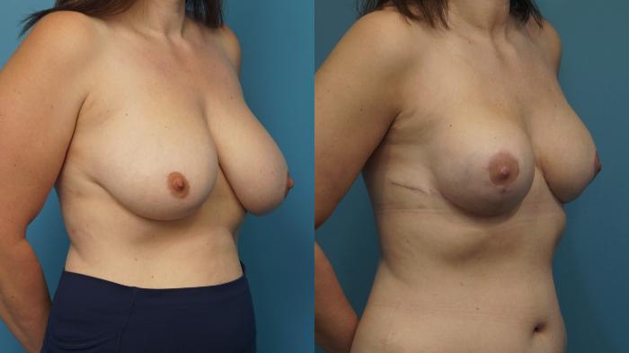 Before & After Breast Reconstruction with Implants Case 453 Right Oblique View in North Shore, IL