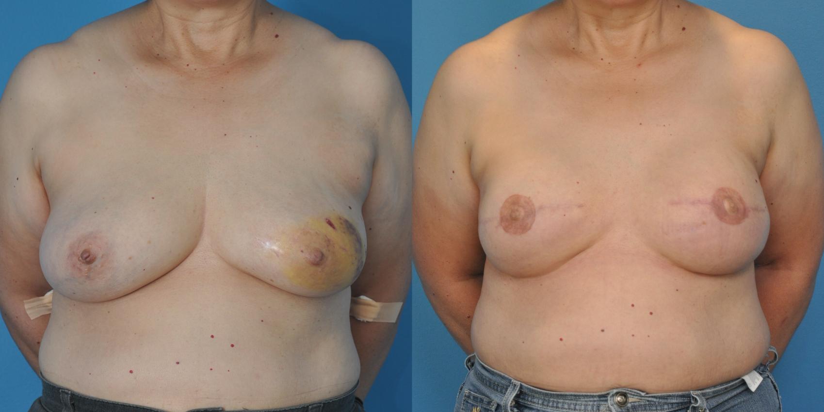 Before & After Breast Reconstruction with Implants Case 46 View #1 View in North Shore, IL