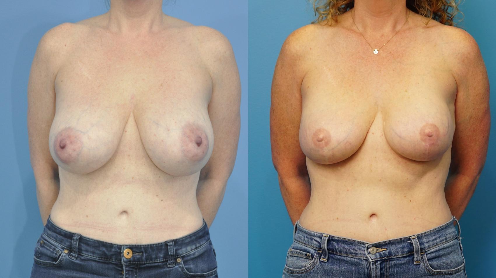 Before & After Breast Reconstruction with Implants Case 471 Front View in North Shore, IL