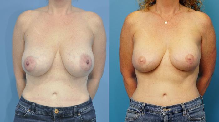 Before & After Nipple Reconstruction and Tattoos Case 471 Front View in North Shore, IL