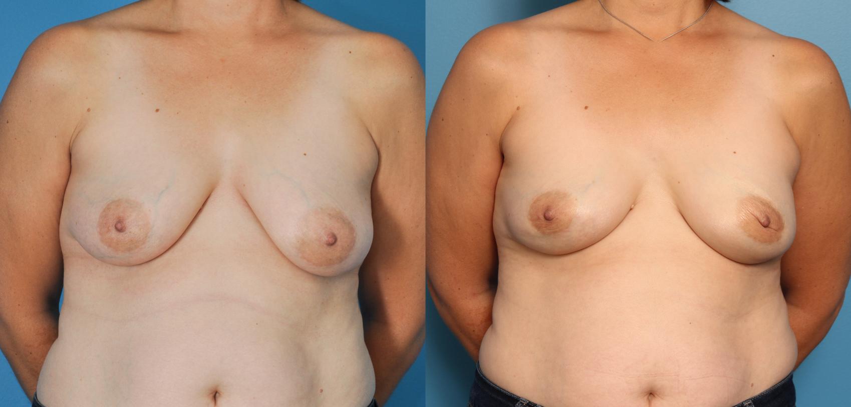 Before & After Breast Reconstruction with Implants Case 57 View #1 View in North Shore, IL