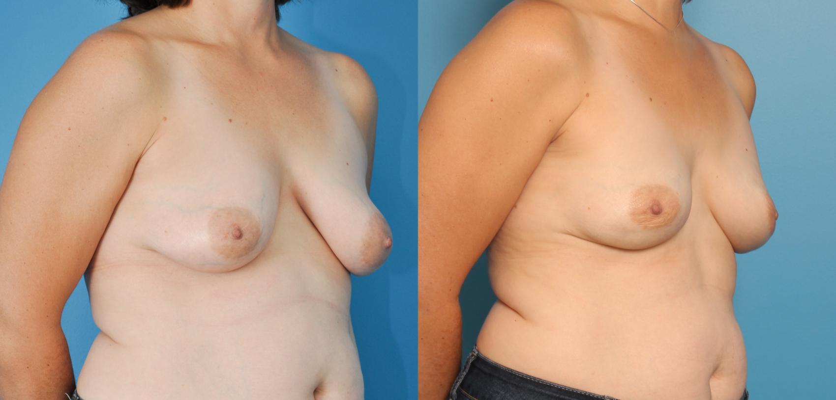Before & After Breast Reconstruction with Implants Case 57 View #2 View in Northbrook, IL