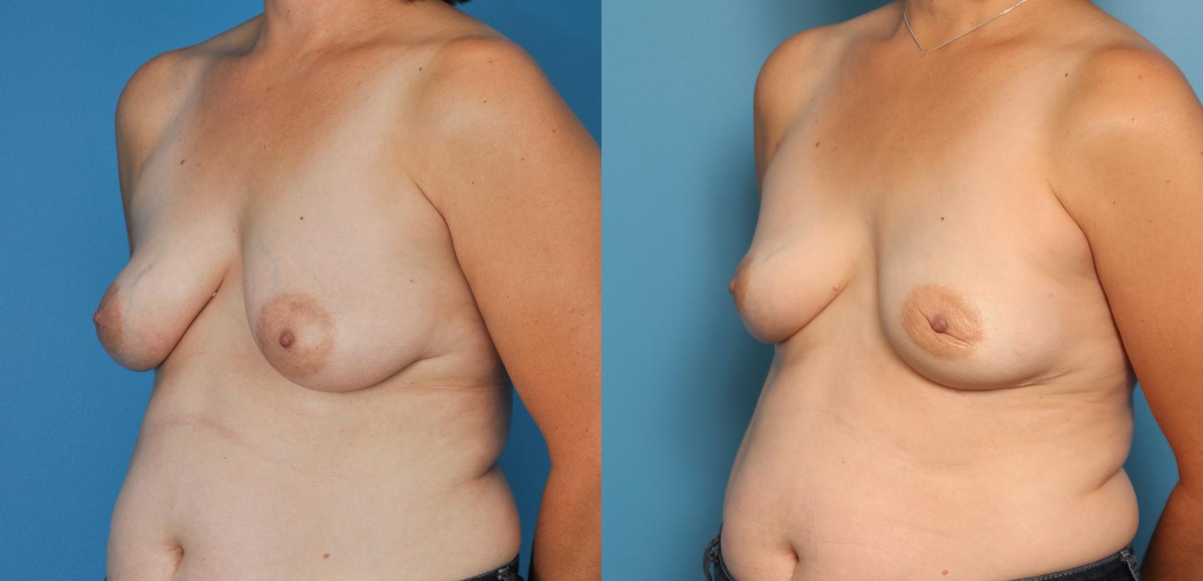 Before & After Breast Reconstruction with Implants Case 57 View #3 View in Northbrook, IL