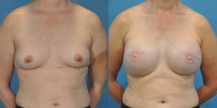 Before & After Breast Reconstruction with Implants Case 58 View #1 View in North Shore, IL