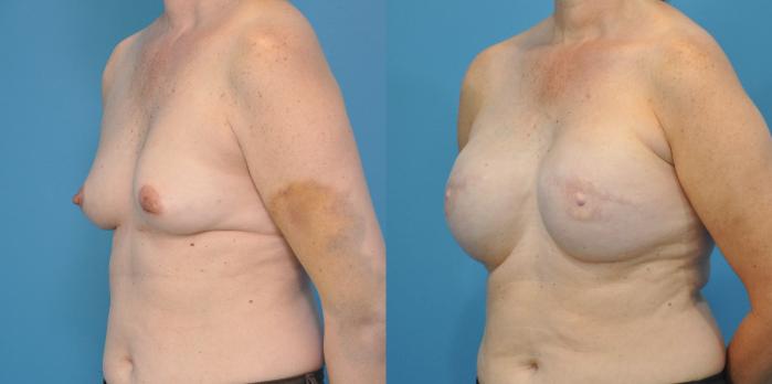 Before & After Breast Reconstruction with Implants Case 58 View #2 View in North Shore, IL