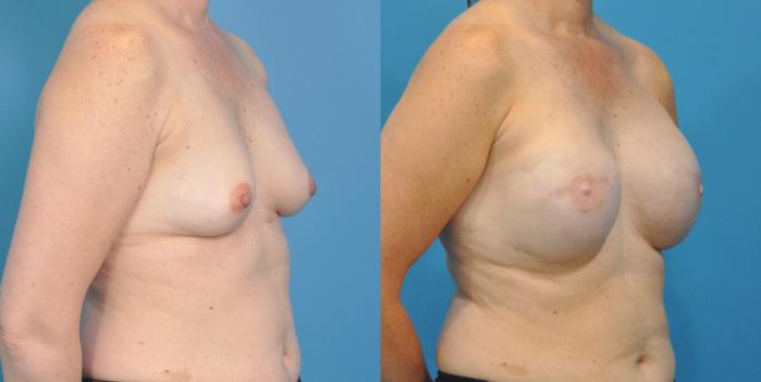 Before & After Breast Reconstruction with Implants Case 58 View #3 View in North Shore, IL