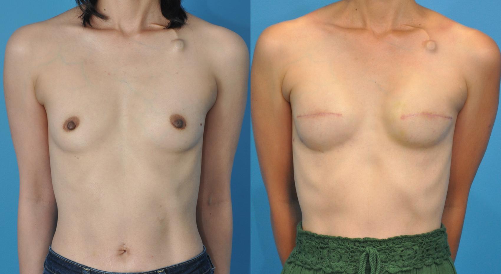 Before & After Breast Reconstruction with Implants Case 60 View #1 View in North Shore, IL