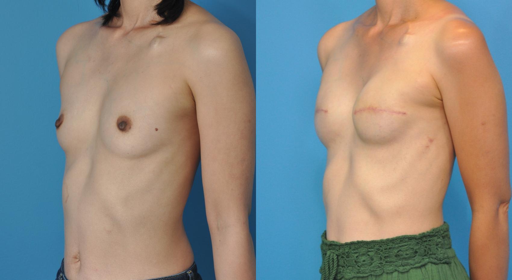 Before & After Breast Reconstruction with Implants Case 60 View #2 View in Northbrook, IL