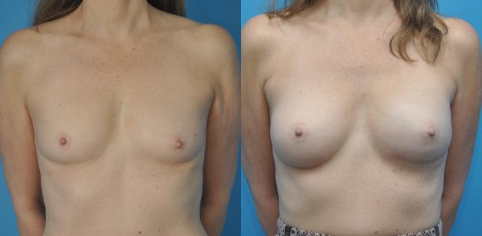 Before & After Breast Reconstruction with Implants Case 64 View #1 View in North Shore, IL