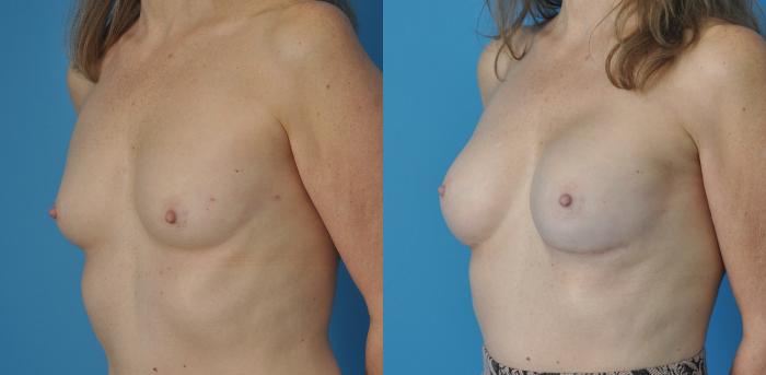 Before & After Breast Reconstruction with Implants Case 64 View #2 View in North Shore, IL