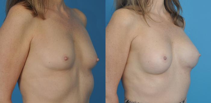 Before & After Breast Reconstruction with Implants Case 64 View #3 View in North Shore, IL