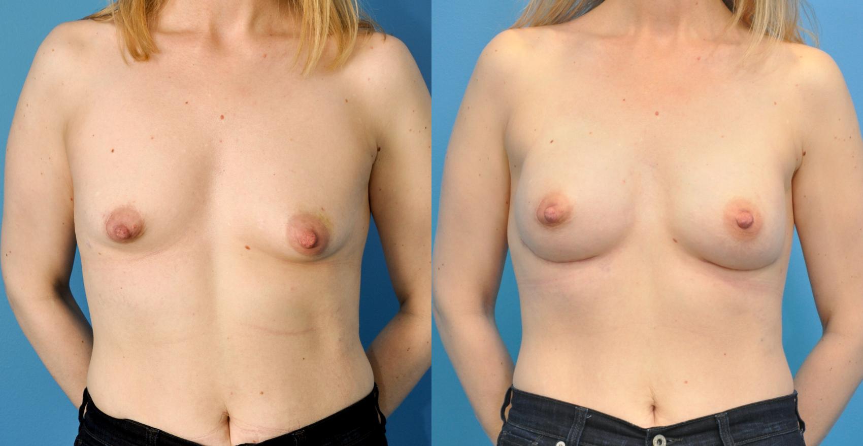 Before & After Breast Reconstruction with Implants Case 67 View #1 View in North Shore, IL