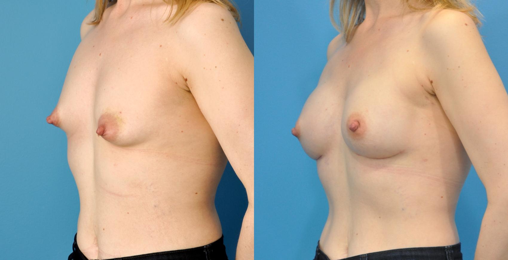 Before & After Breast Reconstruction with Implants Case 67 View #2 View in Northbrook, IL