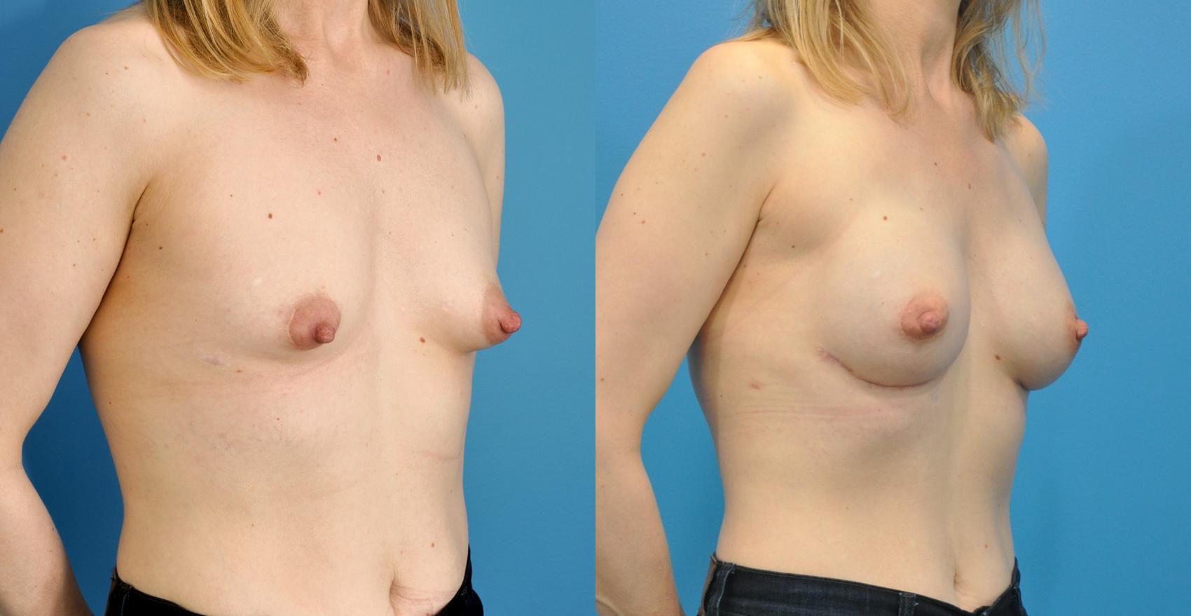 Before & After Breast Reconstruction with Implants Case 67 View #3 View in Northbrook, IL