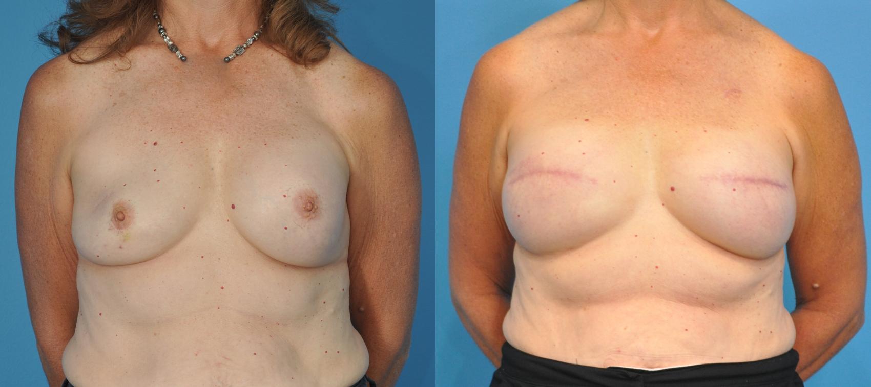 Before & After Breast Reconstruction with Implants Case 72 View #1 View in Northbrook, IL