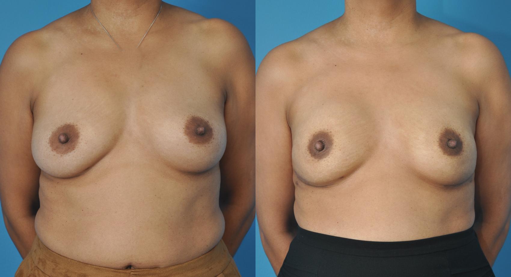 Before & After Breast Reconstruction with Implants Case 74 View #1 View in North Shore, IL