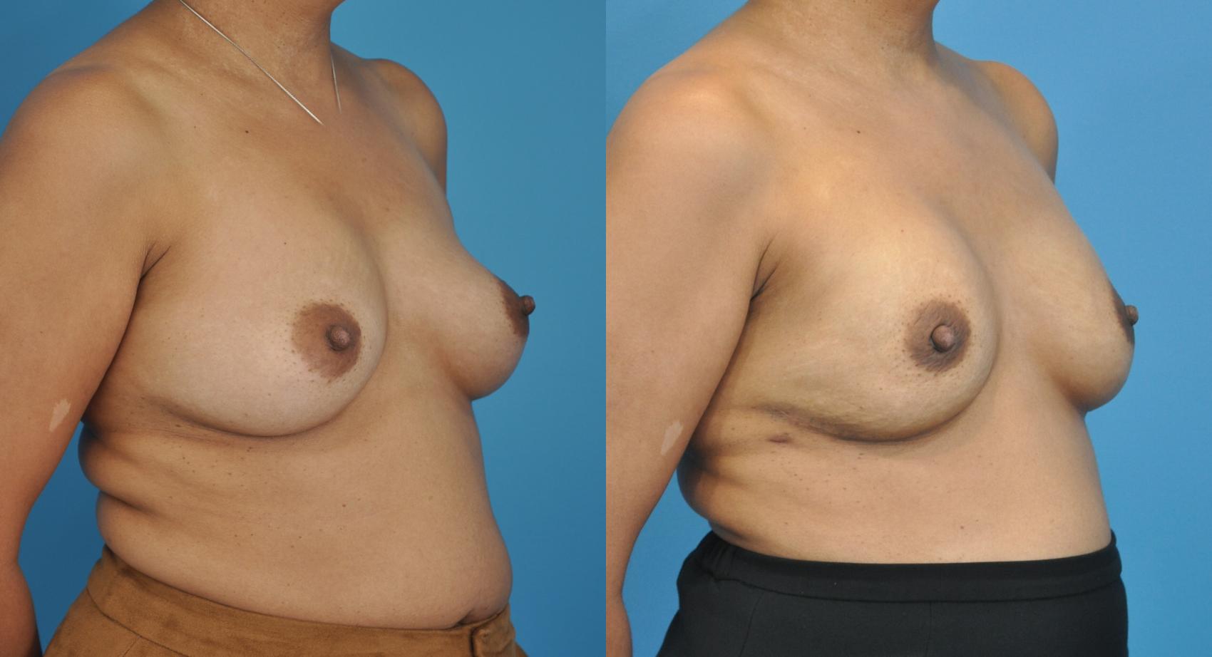 Before & After Breast Reconstruction with Implants Case 74 View #2 View in Northbrook, IL