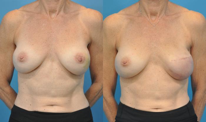 Before & After Breast Reconstruction with Implants Case 78 View #1 View in Northbrook, IL