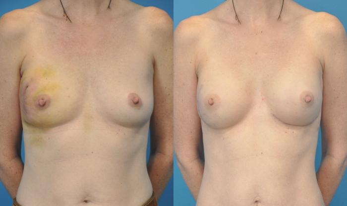 Before & After Breast Reconstruction with Implants Case 81 View #1 View in Northbrook, IL