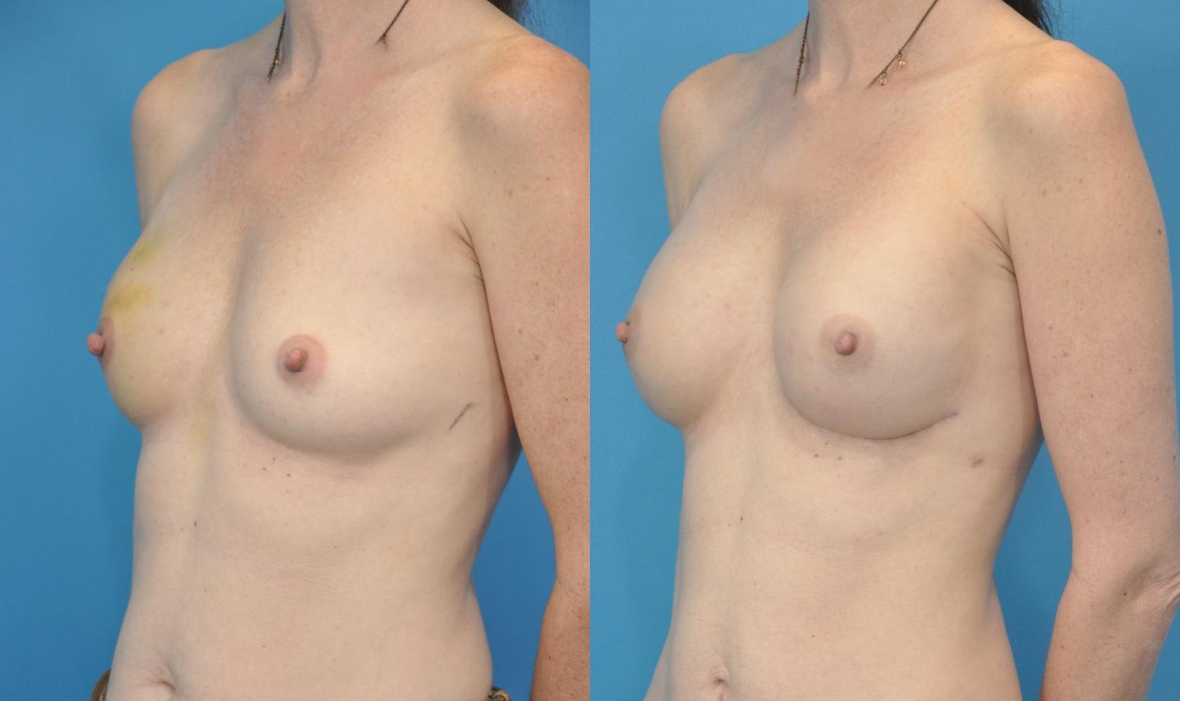 Before & After Breast Reconstruction with Implants Case 81 View #2 View in Northbrook, IL