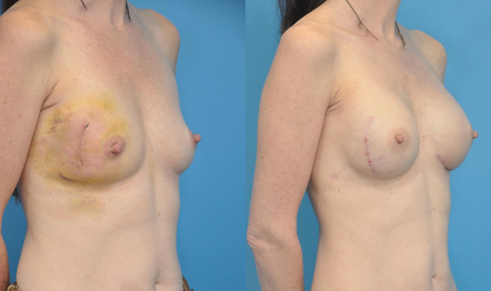 Before & After Breast Reconstruction with Implants Case 81 View #3 View in Northbrook, IL