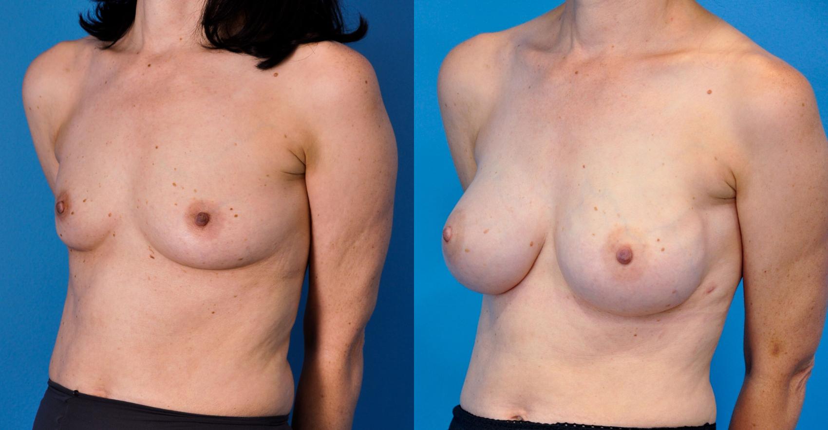 Before & After Breast Reconstruction with Implants Case 9 View #1 View in Northbrook, IL