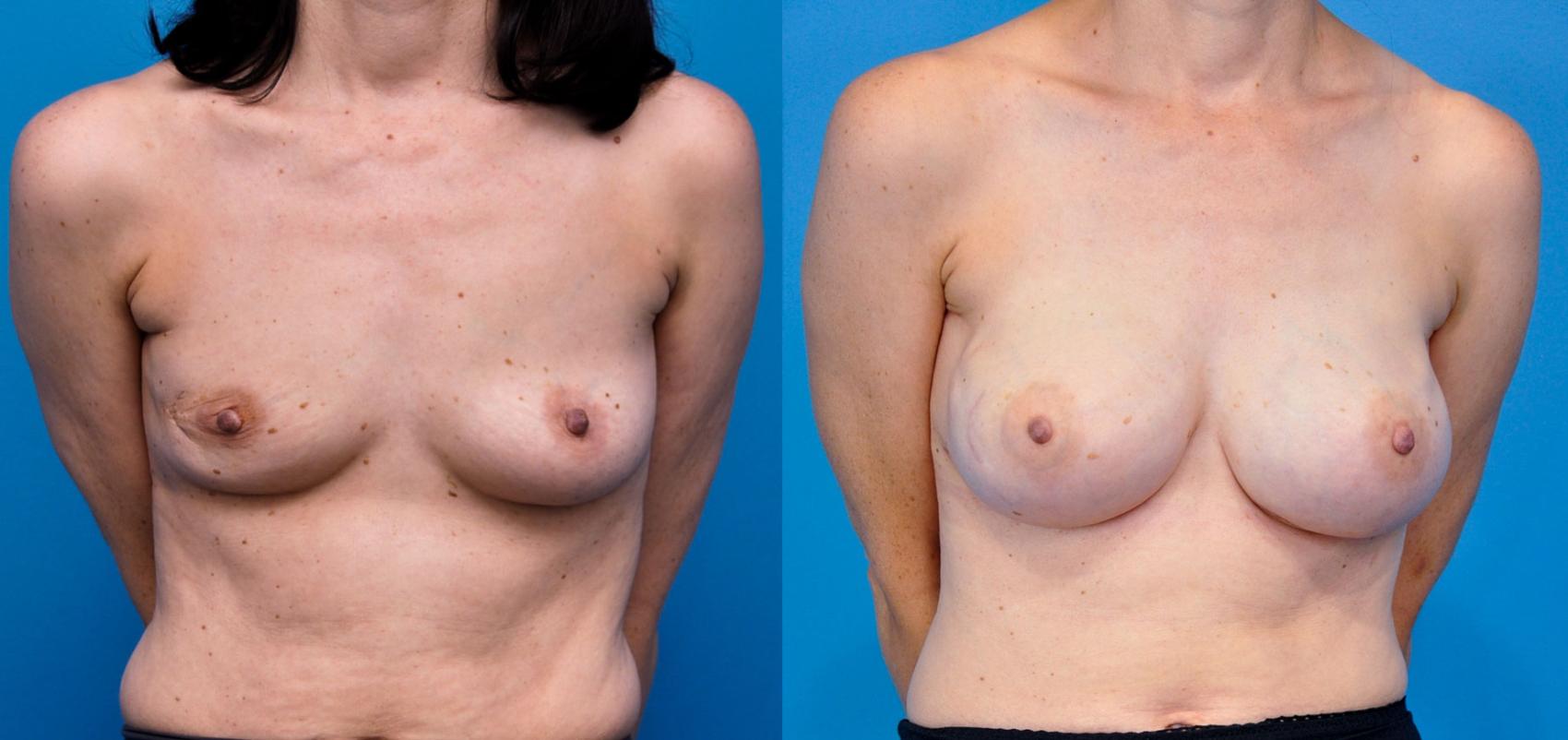 Before & After Breast Reconstruction with Implants Case 9 View #2 View in Northbrook, IL