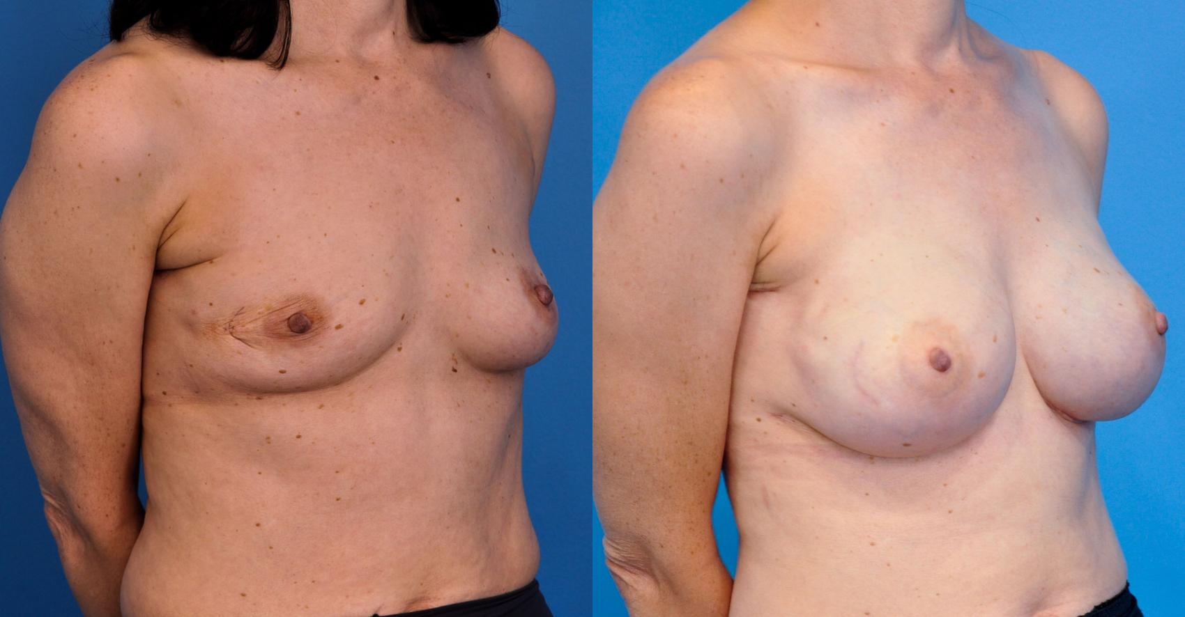 Before & After Breast Reconstruction with Implants Case 9 View #3 View in Northbrook, IL