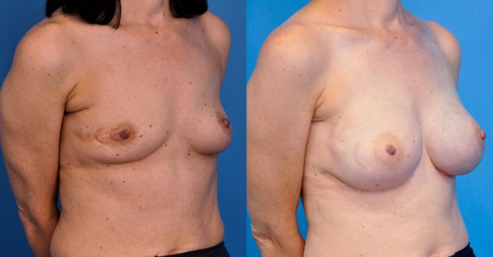 Before & After Breast Reconstruction with Implants Case 9 View #3 View in Northbrook, IL