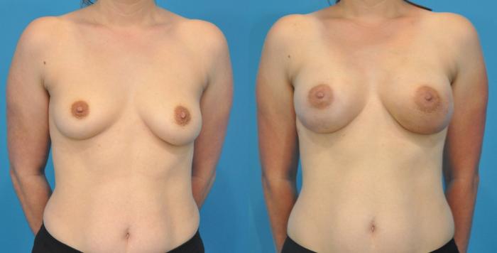 Before & After Breast Reconstruction with Implants Case 93 View #1 View in North Shore, IL
