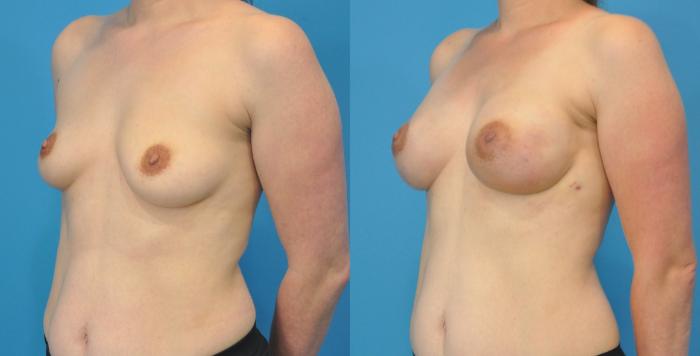 Before & After Breast Reconstruction with Implants Case 93 View #2 View in North Shore, IL