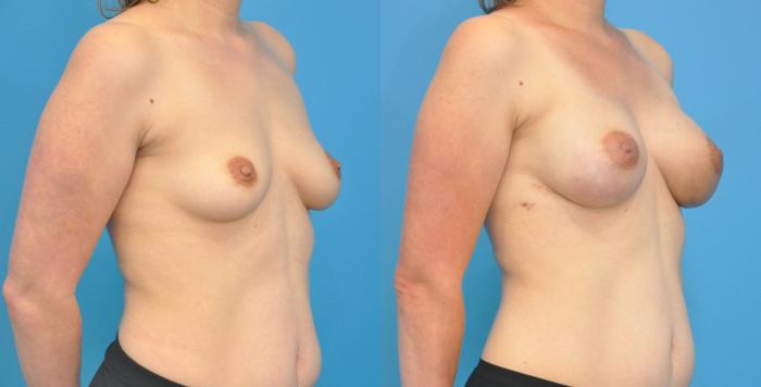 Before & After Breast Reconstruction with Implants Case 93 View #3 View in North Shore, IL