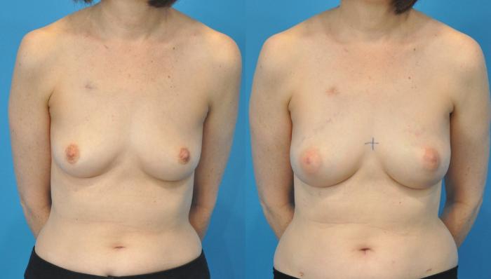 Before & After Breast Reconstruction with Implants Case 94 View #1 View in North Shore, IL