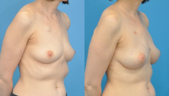 Before & After Breast Reconstruction with Implants Case 94 View #2 View in North Shore, IL
