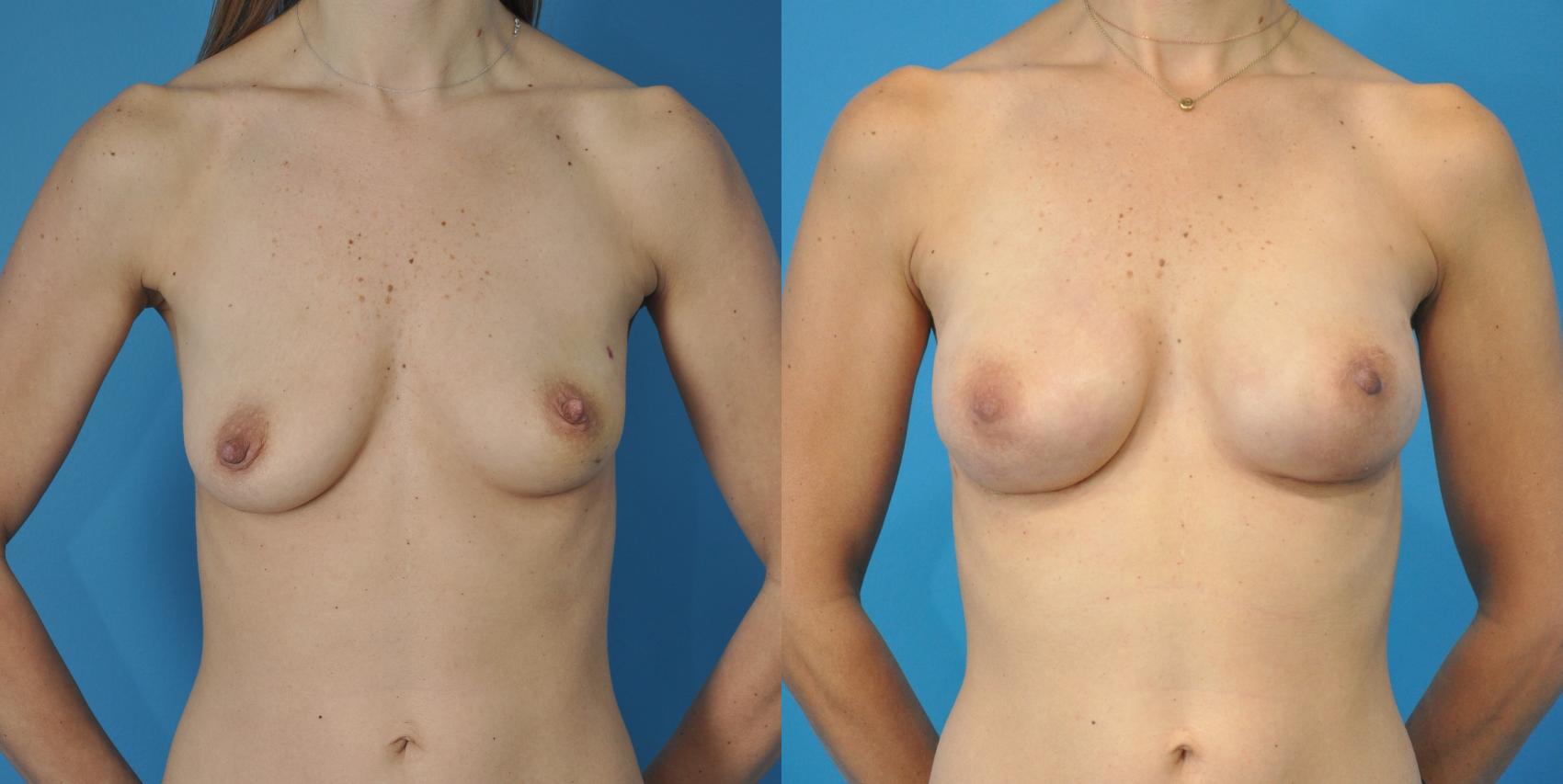 Before & After Breast Reconstruction with Implants Case 97 View #1 View in North Shore, IL