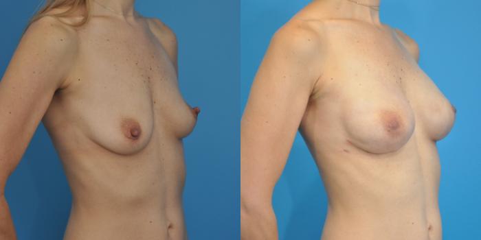 Before & After Breast Reconstruction with Implants Case 97 View #2 View in North Shore, IL