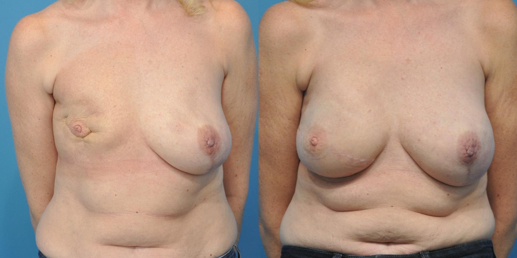 Before & After Breast Reconstruction with Latissimus Flaps Case 154 View #1 View in Northbrook, IL