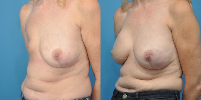 Before & After Breast Reconstruction with Latissimus Flaps Case 154 View #2 View in Northbrook, IL