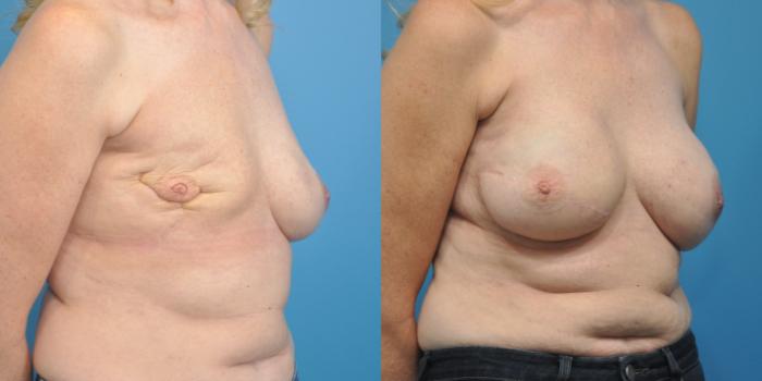 Before & After Breast Reconstruction with Latissimus Flaps Case 154 View #3 View in Northbrook, IL