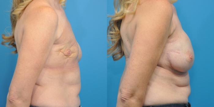 Before & After Breast Reconstruction with Latissimus Flaps Case 154 View #4 View in Northbrook, IL
