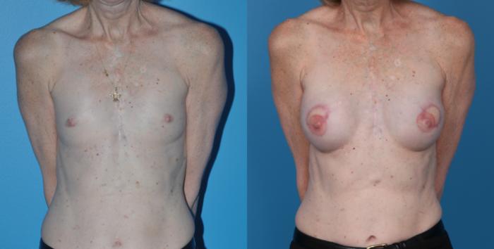 Before & After Breast Reconstruction with Latissimus Flaps Case 25 View #1 View in Northbrook, IL
