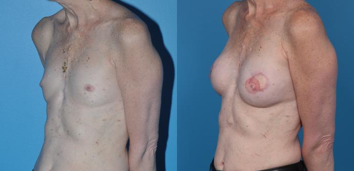 Before & After Breast Reconstruction with Latissimus Flaps Case 25 View #2 View in North Shore, IL