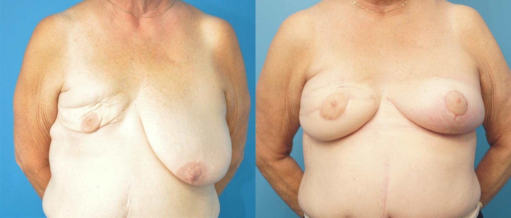 Before & After Breast Reconstruction with Latissimus Flaps Case 292 Front View in North Shore, IL