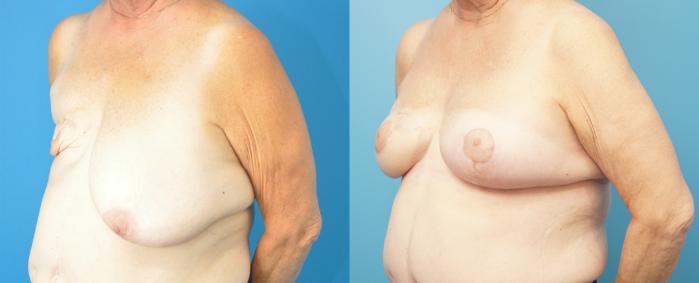 Before & After Breast Reconstruction with Latissimus Flaps Case 292 Left Oblique View in North Shore, IL